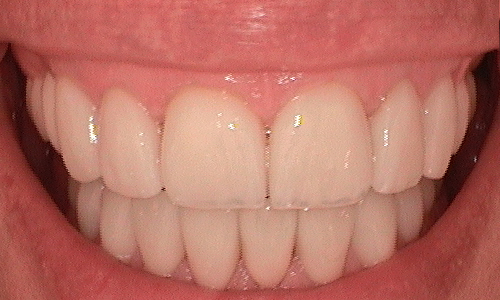 After full mouth reconstruction in Harley Street - 46 year old lady