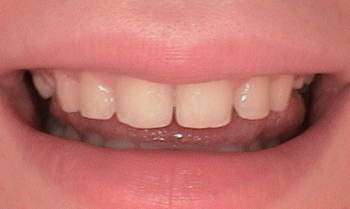 Before full mouth reconstruction in Harley Street - 18 year old lady
