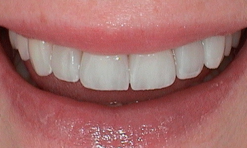 After porcelain veneer treatment in Harley Street - 39 year old lady