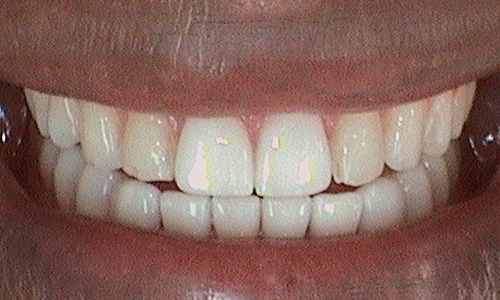 After some of the best veneers in London Harley Street - 42 year old diplomat