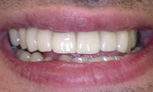 After veneers teeth