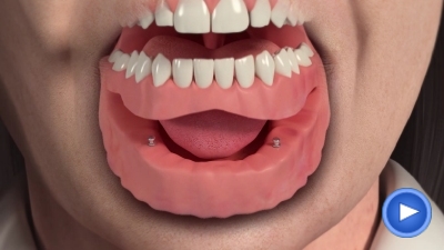 Ball-retained Overdentures