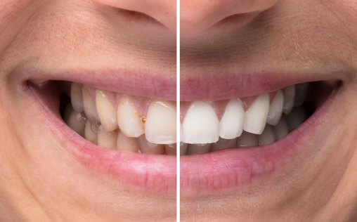 Examples of Teeth Whitening near me