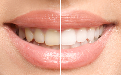 Examples of our Harley Street teeth whitening